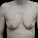 Breast Lift with Implants Before & After Patient #24697