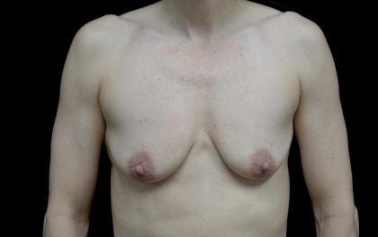 Breast Lift with Implants Before & After Patient #24697