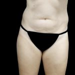 Liposuction Before & After Patient #24698