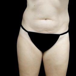 Liposuction Before & After Patient #24698