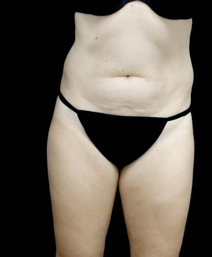 Liposuction Before & After Patient #24698