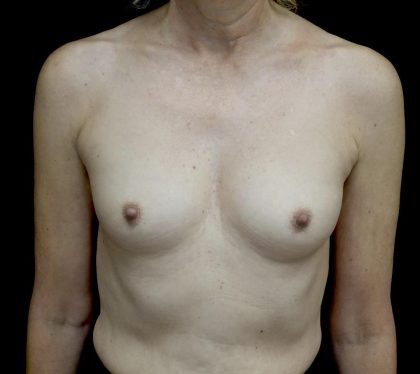 Breast Augmentation (Implants) Before & After Patient #24694