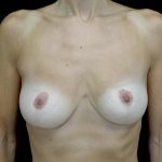 Breast Reduction Before & After Patient #24695