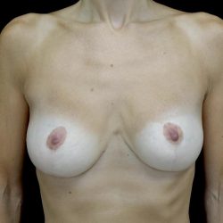 Breast Reduction Before & After Patient #24695