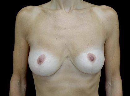 Breast Reduction Before & After Patient #24695