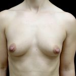 Breast Augmentation (Fat Transfer) Before & After Patient #24696