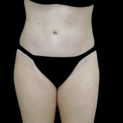 Liposuction Before & After Patient #24698