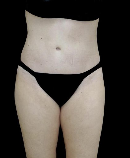 Liposuction Before & After Patient #24698
