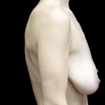 Breast Reduction Before & After Patient #24695