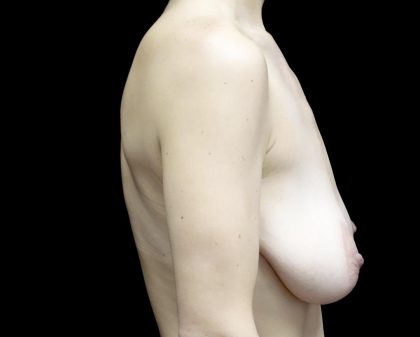 Breast Reduction Before & After Patient #24695