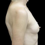 Breast Augmentation (Implants) Before & After Patient #24694