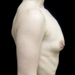 Breast Augmentation (Fat Transfer) Before & After Patient #24696