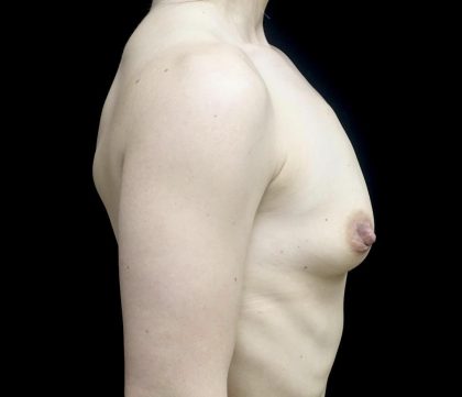 Breast Augmentation (Fat Transfer) Before & After Patient #24696