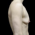 Breast Lift with Implants Before & After Patient #24697