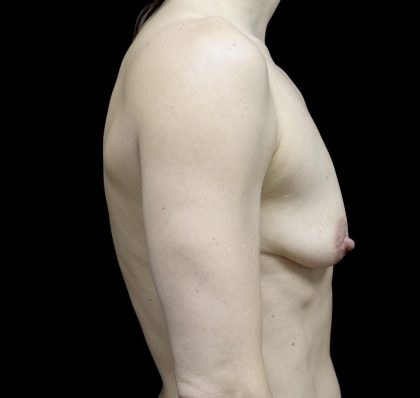 Breast Lift with Implants Before & After Patient #24697