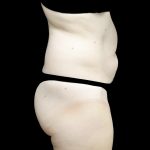 Liposuction Before & After Patient #24698