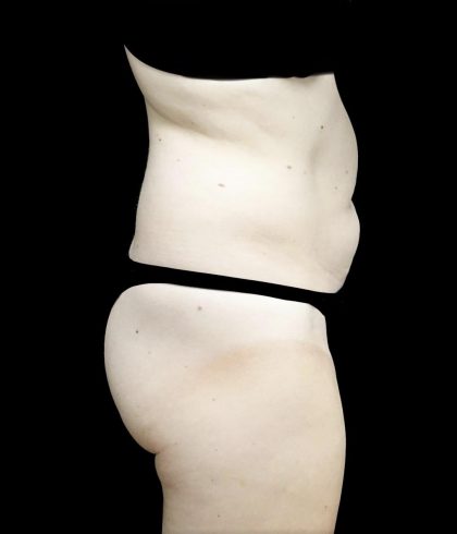 Liposuction Before & After Patient #24698
