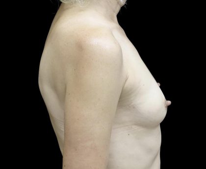 Breast Augmentation (Implants) Before & After Patient #24694