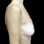Breast Reduction Before & After Patient #24695