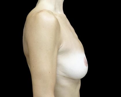 Breast Reduction Before & After Patient #24695