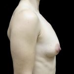 Breast Augmentation (Fat Transfer) Before & After Patient #24696