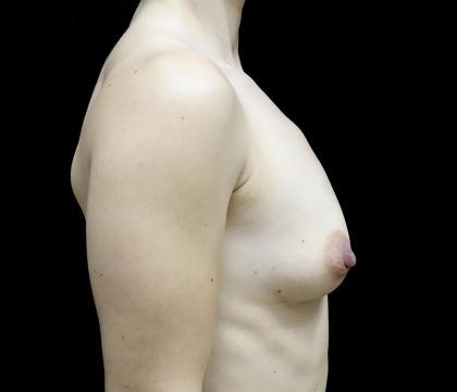 Breast Augmentation (Fat Transfer) Before & After Patient #24696