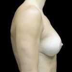 Breast Lift with Implants Before & After Patient #24697