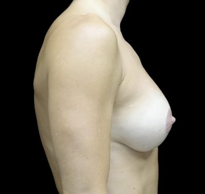 Breast Lift with Implants Before & After Patient #24697
