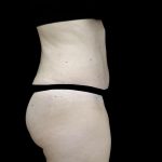 Liposuction Before & After Patient #24698