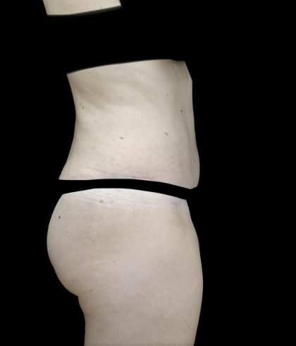 Liposuction Before & After Patient #24698