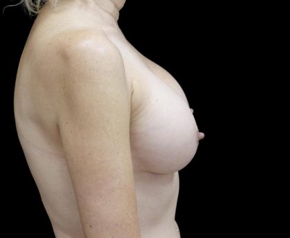 Breast Augmentation (Implants) Before & After Patient #24694