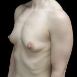 Breast Augmentation (Fat Transfer) Before & After Patient #24696