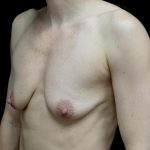 Breast Lift with Implants Before & After Patient #24697
