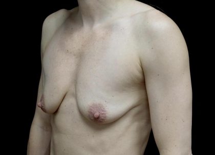 Breast Lift with Implants Before & After Patient #24697