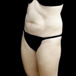 Liposuction Before & After Patient #24698