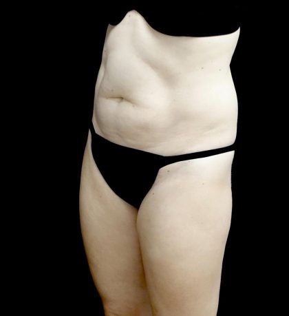 Liposuction Before & After Patient #24698