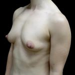 Breast Augmentation (Fat Transfer) Before & After Patient #24696