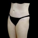 Liposuction Before & After Patient #24698