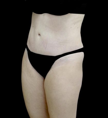 Liposuction Before & After Patient #24698