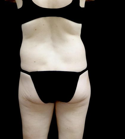 Liposuction Before & After Patient #24698