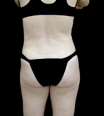 Liposuction Before & After Patient #24698