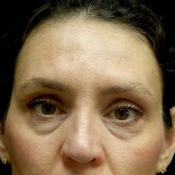Blepharoplasty Before & After Patient #24768