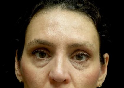 Blepharoplasty Before & After Patient #24768