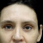 Blepharoplasty Before & After Patient #24768
