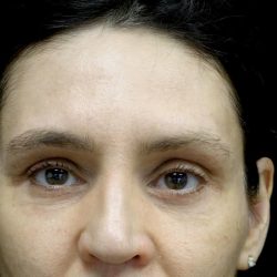 Blepharoplasty Before & After Patient #24768
