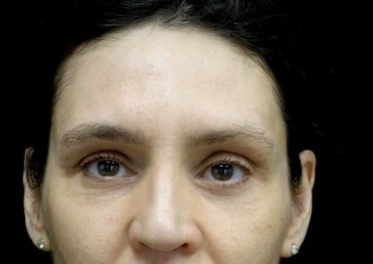 Blepharoplasty Before & After Patient #24768