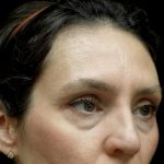 Blepharoplasty Before & After Patient #24768