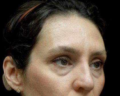 Blepharoplasty Before & After Patient #24768