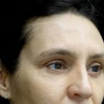 Blepharoplasty Before & After Patient #24768