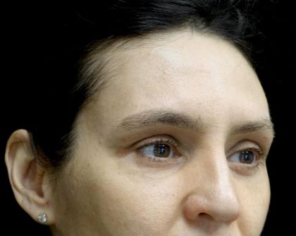 Blepharoplasty Before & After Patient #24768
